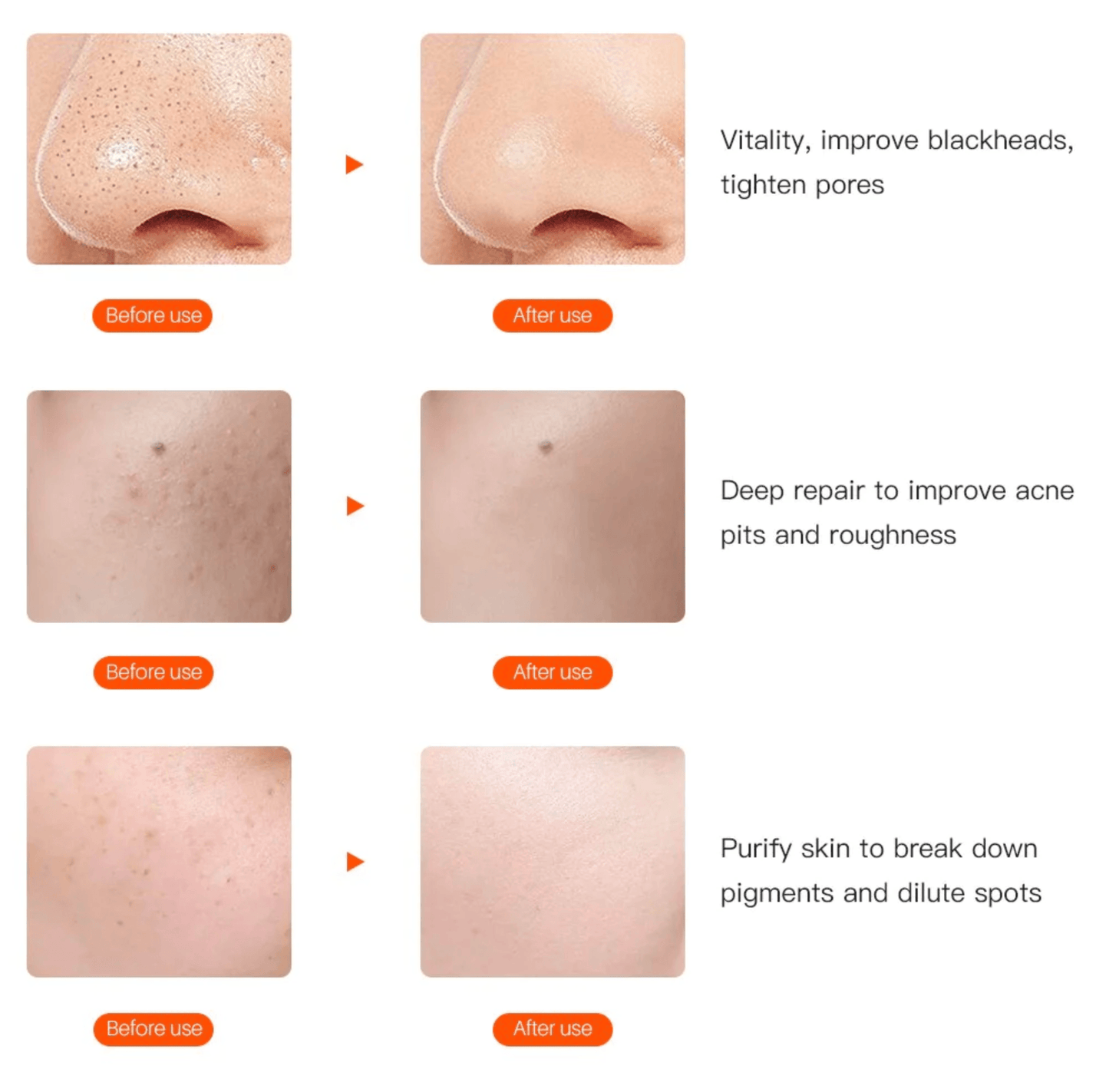 Lighteme LED-Lichttherapiemaske