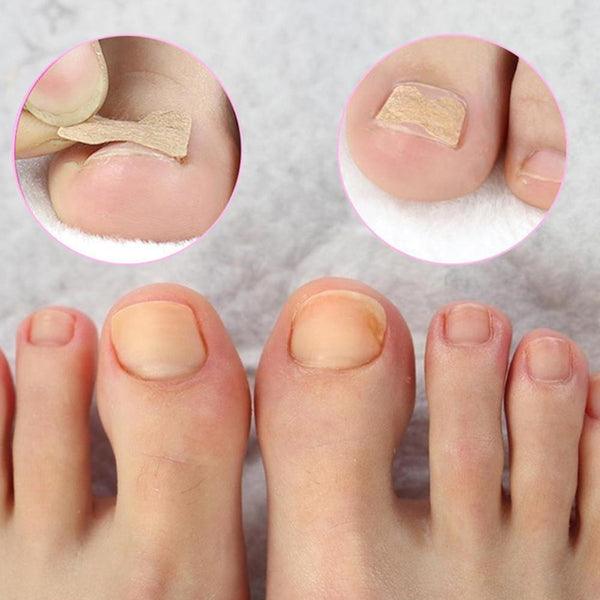 Lighteme Nagelpflaster &amp; Nagelpatches – Schmerzfreie Nagelpflege